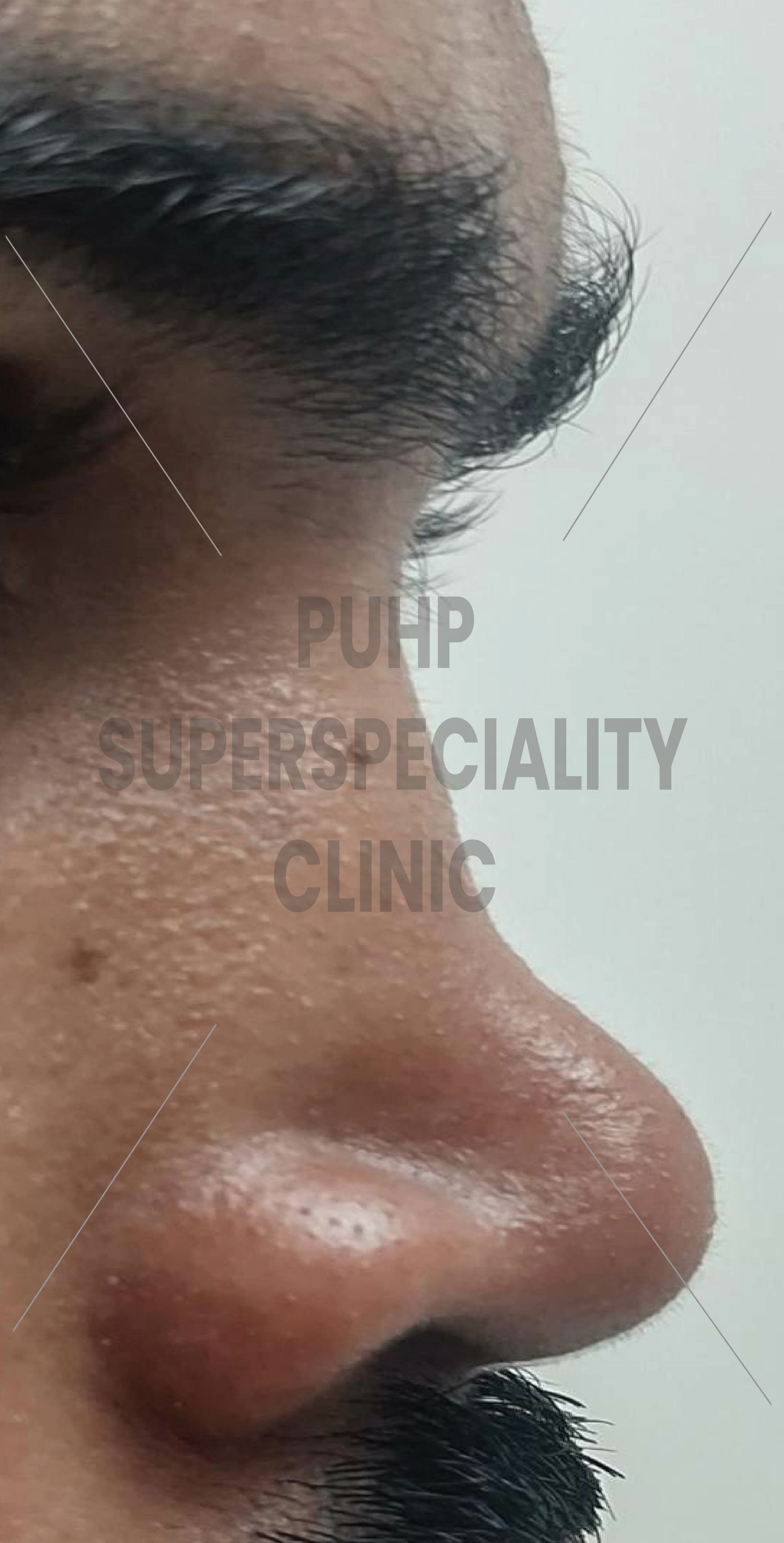 Rhinoplasty