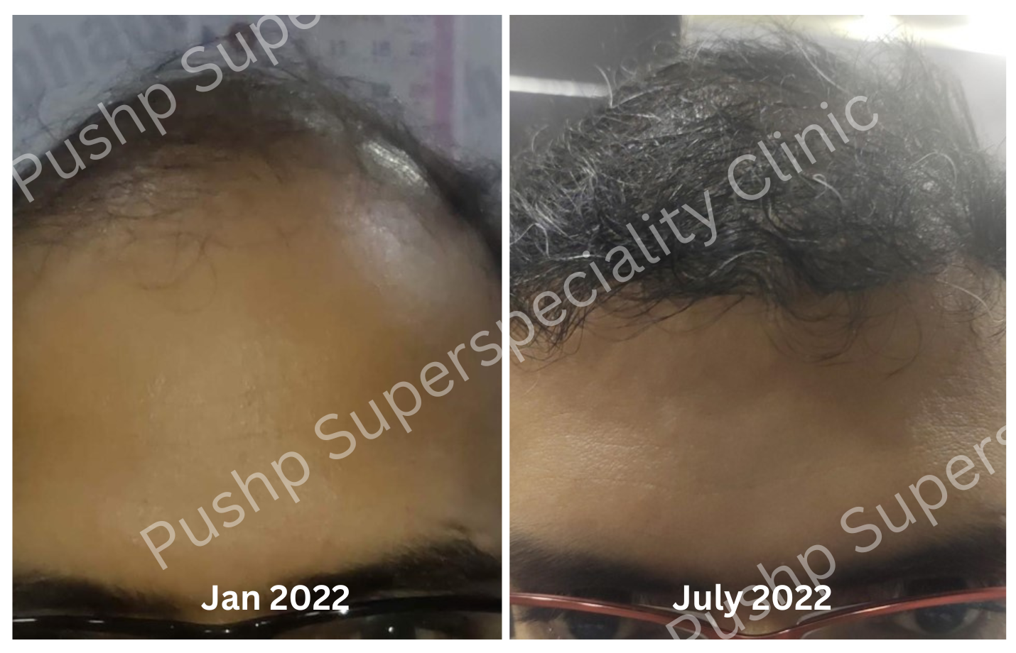 Hair Transplant Surgery Results - Dr. Sandeep Naphade